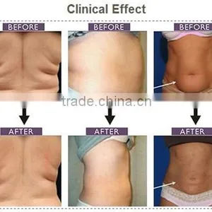 High Quality Homeuse 650nm 4D Lipo Laser With Microcurrent Slimming Machine for Fat Loss and Body Shaping thumbnail-6