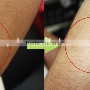 Permanent Hair Removal Diode Laser 810nm Diode Lazer/diode Laser 808 thumbnail-3