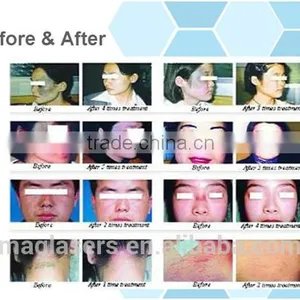 Wart Removal Low Price Multifunctional Co2 Laser Fractional Machine/laser Clinic And Medical Uses Vaginal Rejuvenation thumbnail-6