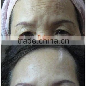 Anti-wrinkle And Anti-aging Machine Type and Ultrasonic Operation System HIFU Face Lift Machine thumbnail-5
