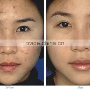 40W Fractional CO2 Laser Acne Scar & Wrinkle Removal / Co2 Laser Surgical Product Vaginal Applicator thumbnail-3