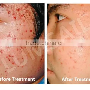 LED PDT System With 2 Treatment Arm For Skin Care Beauty Equipment thumbnail-2