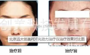 Red Led Light Therapy Skin 2016 New! Cheap Professional PDT Led Beauty Machine For Acne Removal Skin Care Skin Whitening thumbnail-6