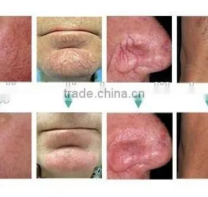 Zhengjia Mecical Spider Veins Vascular Removal High Frequency Beauty Machine thumbnail-6