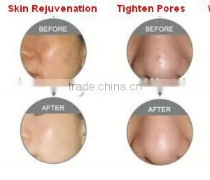 Woman Beauty Machine RF Fractional CO2 Laser Carboxytherapy Vaginal Tightening And Rejuvenation Treatment With Medical CE Skin Tightening thumbnail-2