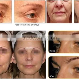 2016 Promotion Low Price Beauty Machine Expression Lines Removal HIFU Three Treatment Tips HIFU Skin Tightening thumbnail-4