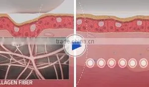 Skin Tighten HIFU Machine!!! Vaginal Tightening HIFU /HIFU Hips Shaping Wrinkles Removal Machine For Sale Back Tightening thumbnail-4