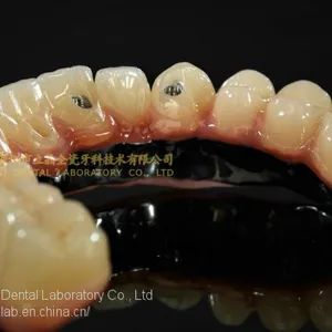 Full-arch Implant Bridge Prosthesis, Implant Denture Framework, Implant Prosthesis, Laboratoire Dentaire, Dentallabor, Laboratorio Dental, Dental Laboratory, Shenzhen LJ Dental Lab China thumbnail-4