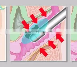 YUWEI Most Professional Hifu Technology Hifu 2000 Shots Vaginal Tightening Beauty Machine With Good Price Deep Wrinkle Removal thumbnail-5