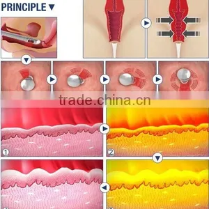 1.0-10mm 2016 Hot Selling Ultrasonic Hifu Vaginal Tightening Machine Skin Tightening thumbnail-5
