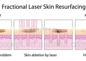 Wart Removal Vagina Cleaning Skin Resurfacing Fractional Co2 Birth Multifunctional 40w Mark Removal Face Whitening Laser Machine Face Lifting Warts Removal thumbnail-2