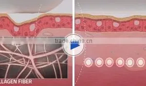 Skin Tightening HIFU Vaginal Tightening Machine/Skin No Pain Rejuvenation Machine/HIFU Machine Deep Wrinkle Removal thumbnail-4