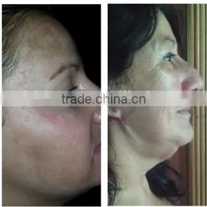 MINI Radio Frequency Skin Rejuvenation and Face Liftin thumbnail-5