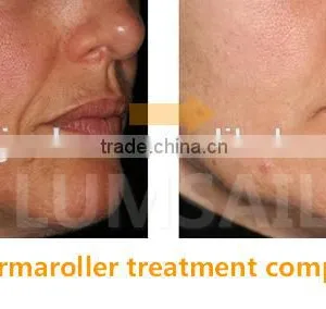 3 in 1 Derma Roller Dermaroller for Treatment of Acne Scars and Healing Wounds thumbnail-5