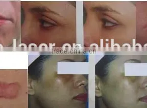 Eye Wrinkle / Bag Removal Fractional Co2 Laser 0.1mj-300mj Stretch Mark Removal Acne Scar Removal Machine Warts Removal thumbnail-3