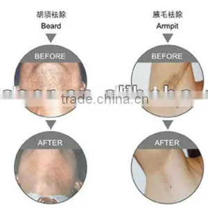 2015 Hongkong Beauty Expo 808nm Diode Laser Hair Removal Machine thumbnail-5