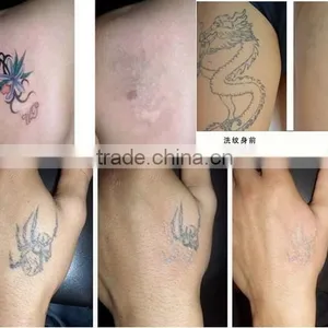 *Stationary 1064 nm 532nm Q-swithed Nd-yag Laser Alexandrite Laser Tattoo Removal Beauty Machine thumbnail-6