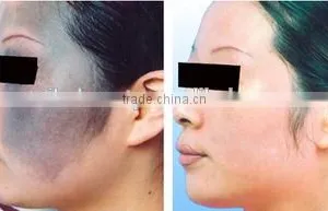 1064nm China Factory Provide Q Switch 1 HZ Age Spot Removal Picosecond Laser Machine thumbnail-5