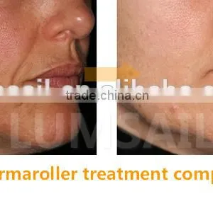 New 2016 Skin Care Derma Roller Dermaroller for Acne Removal Beauty Equipment thumbnail-4