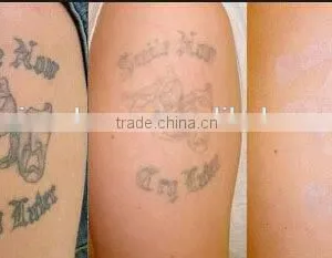 Tattoo Pigment Removal Beauty Machine thumbnail-4
