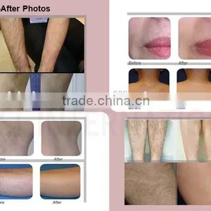 2016 New Arrival Most Advanced 808nm Diode Laser /diode Laser Hair Removal/ Diode Laser 808 thumbnail-6