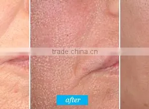 ER Yag Laser Acne Treatment Scar Removal Machine Erbium Laser Remove Chloasma CO2 Laser thumbnail-5