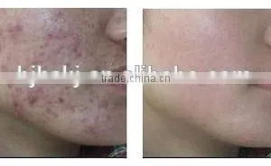 Portable Fractional Co2 Laser Surgical Products thumbnail-4