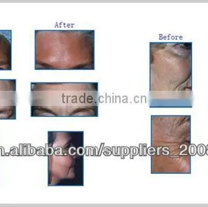 YUWEI 2016 Best Seller RF Home Use Face Lift Devices Eye Wrinkle Removal Eye Care Massage thumbnail-6