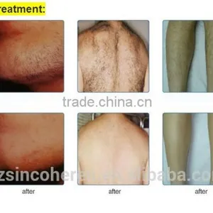 Sincoheren FDA CE Approved Hair Removal Machine,OPT FP Technology NYC-3 thumbnail-4