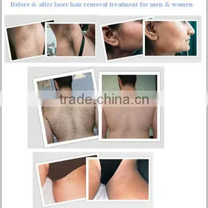 Factory Direct Sale Safe Powerful and More Professional Home Alma Laser Hair Removal Machine for Sale thumbnail-6
