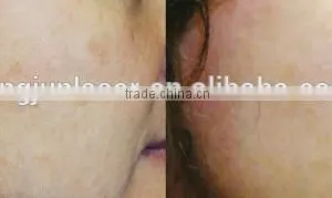 1 HZ Q Switch Laser Tattoo Removal Machine For Skin Tattoo Treatment 1-10Hz thumbnail-5