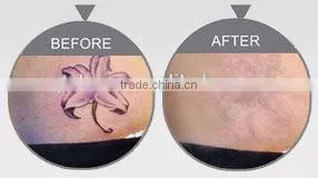 Competitive Q Switch Nd Yag Laser Tattoo Varicose Veins Treatment Removal Laser Machines Naevus Of Ota Removal thumbnail-3