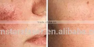 8.4 Inch Touch Screen Vascular Removal /High Frequency Vascular Removal thumbnail-4