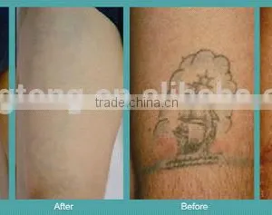 The Unique Tattoo Removal Machine Vascular Tumours Treatment Home Yag Laser Machine Med-810 1000W thumbnail-6