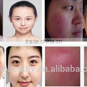 Beauty Cosmetics Laser Vascular Removal 980nm Diode Laser Spider Vein Removal Machine thumbnail-6