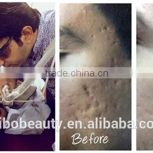 Birth Mark Removal Best Price !! Dermatology Laser Co2 Fractional Machine FDA Approved Skin Tightening / Vertical Co2 Fractional Laser For Vaginal Tightening 1ms-5000ms thumbnail-5