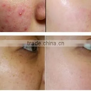 Medical Skin Tightening Fractional Co2 Laser Equipment Skin Treat Telangiectasis Age Spot Removal Rejuvenation Co2 Laser Scar Removal Acne Treatment Face Lifting thumbnail-4