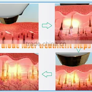 Best Selling Products Shr Diode Lasers 808 nm / Alexandrite Laser 755nm thumbnail-5