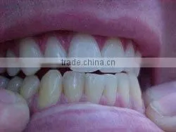 Top Quality LED Teeth Whitening thumbnail-2