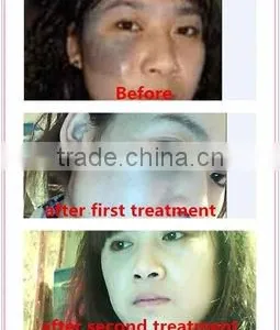 Varicose Veins Treatment Laser Type Physical Therapy Equipment/long Pulse Hori Naevus Removal Nd Yag Laser/best Tattoo Removal Machine thumbnail-6