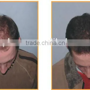 650nm Laser Hair Loss/ Hair Growth Machine (with CE Certification) thumbnail-4