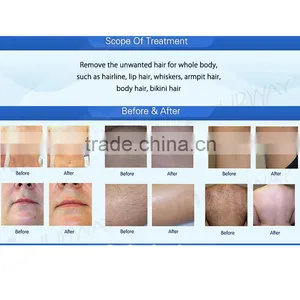 Lip Hair Permanent Hair Removal Laser Hair Removal Machine High Power Skin Rejuvenation 808nm Diode / Diode Laser 808nm 2016 Home thumbnail-6