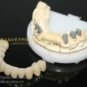Full Metal Post Core, Full Ceramic Post Core, Richmond Crown, Cast Metal Crown, Dental Prostheses, Laboratorio Dental, Dental Laboratory, Dentallabor, LJ Dental Lab China thumbnail-5