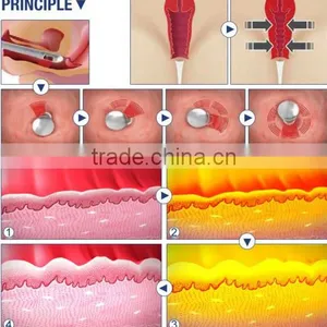 100um-2000um Vaginal Rejuvenation Vaginal Rejuvenation Laser Fractional Skin Resurfacing Co2 Gynecology Therapy Machine Treat Telangiectasis thumbnail-6
