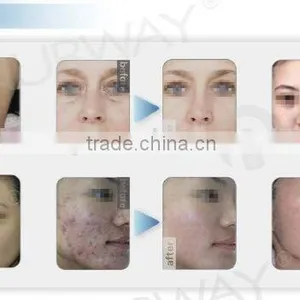 Laser Hair Removal Fda Approved Ipl Laser Machine thumbnail-2