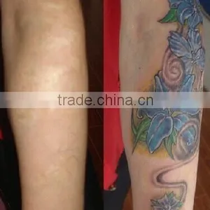 Manufactory Portable nd Yag Tattoo Removal Laser With Medical CE in Cheapest thumbnail-6