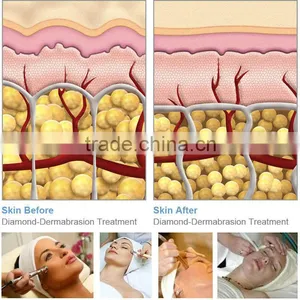 Fast Remove Dead Skin Surface/scars Microdermabrasion Machine thumbnail-3