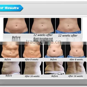 Body Shaping Portable Cryolipolysis Criolipolisis Fat Cryolipolysis Slimming Machine Reducing Machine Cryolipolysis Price 3.5
