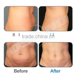Loss Weight Cryolipolysis Slimming Machine / Zeltiq Cryolipolysis Machine For Home Use Skin Tightening thumbnail-6