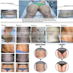 2015 New Products! Best Cryopolysis Machine,Cryopolysis Fat Freezing thumbnail-5